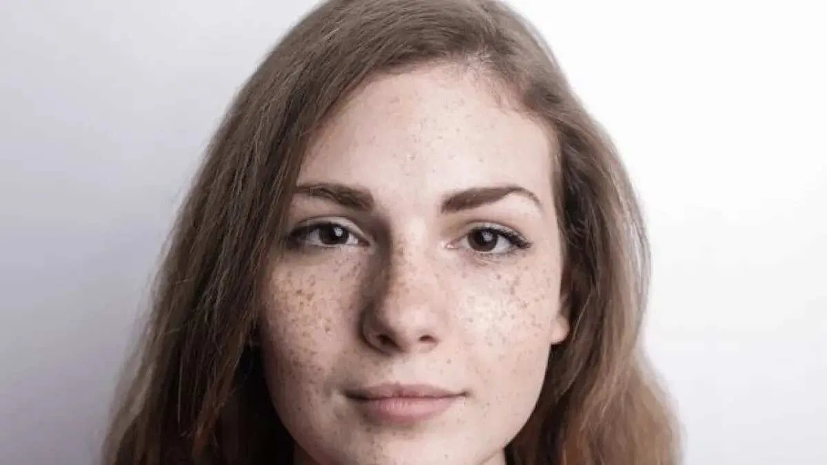 Panduan Skincare untuk Mengatasi Dermatitis Perioral