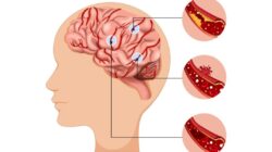 Dampak Sistem Rujukan Terhadap Penanganan Pasien Stroke di Indonesia Dampak Sistem Rujukan Terhadap Penanganan Pasien Stroke di Indonesia